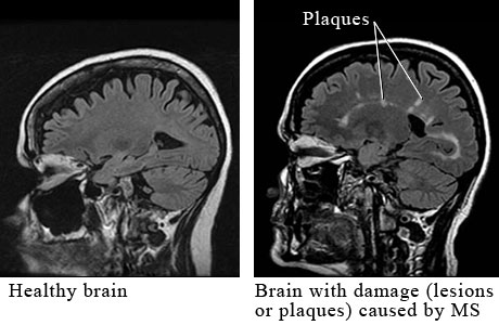 MRI of multiple sclerosis